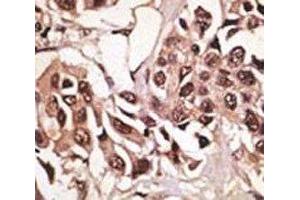 IHC analysis of FFPE human breast carcinoma tissue stained with the BMPR1A antibody (BMPR1A antibody  (AA 21-51))