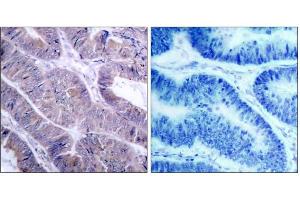 Immunohistochemical analysis of paraffin-embedded human colon carcinoma tissue using AMPK1/AMPK2 (Ab-485/491) antibody (E021130). (PRKAA1/PRKAA2 antibody)
