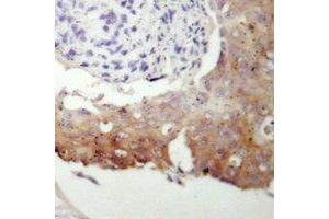 Immunohistochemical analysis of cGK 2 staining in human prostate cancer formalin fixed paraffin embedded tissue section. (PRKG2 antibody  (N-Term))