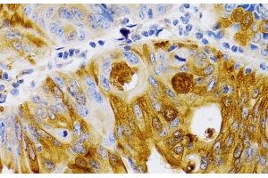 Immunohistochemistry of paraffin-embedded Human colon carcinoma using TFF1 Polyclonal Antibody at dilution of 1:200 (40x lens). (TFF1 antibody)