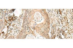 Immunohistochemistry of paraffin-embedded Human esophagus cancer tissue using ZNF397 Polyclonal Antibody at dilution of 1:80(x200) (ZNF397 antibody)