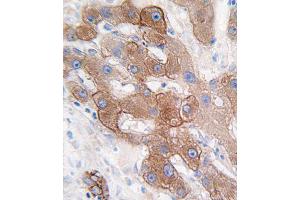 Formalin-fixed and paraffin-embedded human hepatocarcinoma tissue reacted with CYP3A5 antibody (C-term), which was peroxidase-conjugated to the secondary antibody, followed by DAB staining. (CYP3A5 antibody  (C-Term))