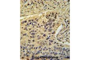 TAF2 Antibody (C-Term) immunohistochemistry analysis in formalin fixed and paraffin embedded human lung carcinoma followed by peroxidase conjugation of the secondary antibody and DAB staining. (TAF2 antibody  (C-Term))