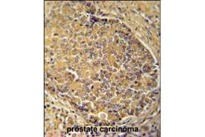 IGSF1 antibody immunohistochemistry analysis in formalin fixed and paraffin embedded human prostate carcinoma followed by peroxidase conjugation of the secondary antibody and DAB staining.