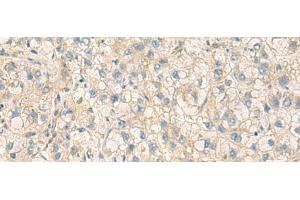 Immunohistochemistry of paraffin-embedded Human liver cancer tissue using PPM1M Polyclonal Antibody at dilution of 1:100(x200) (PPM1M antibody)