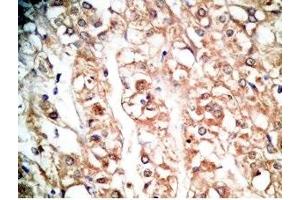 Human kidney cancer tissue was stained by rabbit Anti-BNP-45 (Mouse) Antiserum (BNP-45 antibody  (AA 51-95))