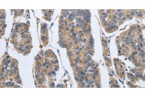 Immunohistochemistry of paraffin-embedded Human breast cancer using IPO7 Polyclonal Antibody at dilution of 1:40 (IPO7 antibody)