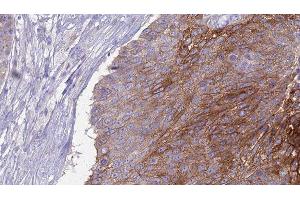 ABIN6276972 at 1/100 staining Human urothelial cancer tissue by IHC-P.