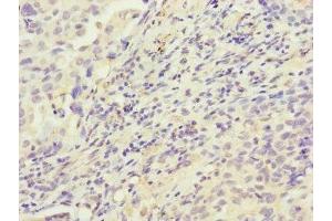 Immunohistochemistry of paraffin-embedded human lung cancer using ABIN7155154 at dilution of 1:100 (HK3 antibody  (AA 1-270))