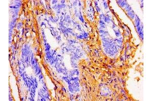Immunohistochemistry of paraffin-embedded human colon cancer using ABIN7149775 at dilution of 1:100 (Desmoglein 1 antibody  (AA 384-539))
