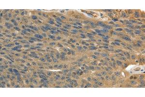 Immunohistochemistry of paraffin-embedded Human ovarian cancer using MSN Polyclonal Antibody at dilution of 1:30 (Moesin antibody)