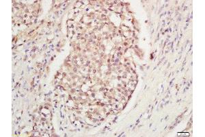 Formalin-fixed and paraffin embedded human laryngeal tissue labeled with Anti-DNA Polymerase gamma Polyclonal Antibody, Unconjugated  at 1:200 followed by conjugation to the secondary antibody and DAB staining. (POLG antibody  (AA 1101-1239))