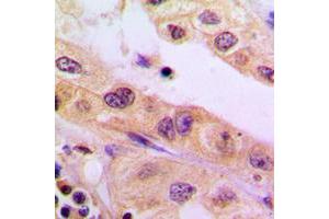 Immunohistochemical analysis of CYB5R3 staining in human liver cancer formalin fixed paraffin embedded tissue section. (CYB5R3 antibody  (Center))