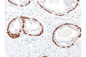 Formalin-fixed, paraffin-embedded human Prostate Cancer stained with p63 Rabbit Polyclonal Antibody. (p63 antibody)