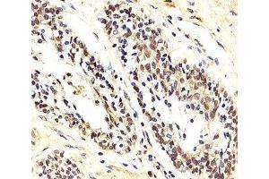 IHC analysis of FFPE human prostate carcinoma section using AKT1/2/3 antibody; Ab was diluted at 1:25. (AKT 1/2/3 antibody  (AA 278-312))