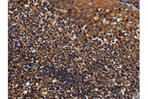 The image on the left is immunohistochemistry of paraffin-embedded Human tonsil tissue using ABIN7129963(KCNK17 Antibody) at dilution 1/60, on the right is treated with fusion protein.