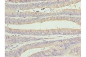 Immunohistochemistry of paraffin-embedded human endometrial cancer using ABIN7146874 at dilution of 1:100 (CSNK1G1 antibody  (Isoform gamma 1))