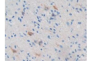 IHC-P analysis of Human Glioma Tissue, with DAB staining. (PRKAB2 antibody  (AA 17-260))