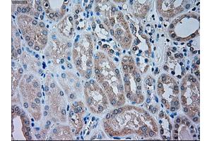 Immunohistochemical staining of paraffin-embedded Carcinoma of liver tissue using anti-TRPM4mouse monoclonal antibody.