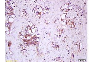 Formalin-fixed and paraffin embedded human colon carcinoma labeled with Rabbit Anti-IL-17RC/IL-17RL Polyclonal Antibody, Unconjugated (ABIN747923) at 1:200 followed by conjugation to the secondary antibody and DAB staining. (IL17RC antibody  (AA 151-250))