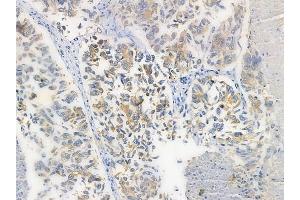 ABIN6260320 and ABIN6272259 at 1/100 staining human lung squamous cell carcinoma by IHC-P.