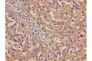 Immunohistochemistry of paraffin-embedded human liver cancer using ABIN7156456 at dilution of 1:100 (Integrin Alpha2b antibody  (AA 639-887))