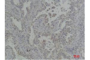 Immunohistochemistry (IHC) analysis of paraffin-embedded Human Lung Carcinoma using Bcl-XlRabbit Polyclonal Antibody diluted at 1:200. (BCL2L1 antibody)