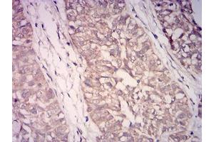Immunohistochemical analysis of paraffin-embedded bladder cancer tissues using WDFY3 mouse mAb with DAB staining.