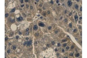 Detection of Hpt in Human Liver cancer Tissue using Monoclonal Antibody to Haptoglobin (Hpt) (Haptoglobin antibody  (AA 168-319))