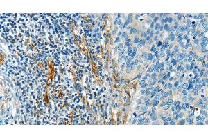 Immunohistochemistry of paraffin-embedded Human cervical cancer tissue using DIO2 Polyclonal Antibody at dilution 1:50 (DIO2 antibody)