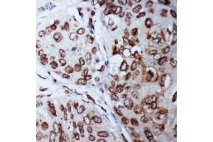 Anti-Lamin B1 antibody, IHC(P) IHC(P): Human Mammary Cancer Tissue (Lamin B1 antibody  (C-Term))
