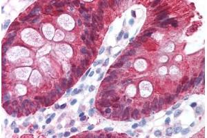 Human Colon (formalin-fixed, paraffin-embedded) stained with CA2 antibody ABIN214579 at 5 ug/ml followed by biotinylated goat anti-rabbit IgG secondary antibody ABIN481713, alkaline phosphatase-streptavidin and chromogen. (CA2 antibody)
