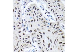 Immunohistochemistry of paraffin-embedded human lung cancer using SMN1 Rabbit mAb (ABIN7270651) at dilution of 1:100 (40x lens). (SMN1 antibody)