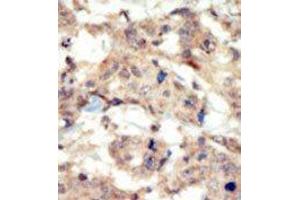 Formalin-fixed and paraffin-embedded human cancer tissue reacted with the primary antibody, which was peroxidase-conjugated to the secondary antibody, followed by DAB staining. (EPH Receptor B6 antibody  (N-Term))
