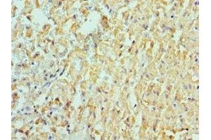 Immunohistochemistry of paraffin-embedded human liver cancer using ABIN7150066 at dilution of 1:100 (ADAM9 antibody  (AA 475-685))