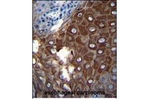 P1 Antibody (Center) (ABIN655817 and ABIN2845241) iunohistochemistry analysis in formalin fixed and paraffin embedded human esophageal carcinoma followed by peroxidase conjugation of the secondary antibody and DAB staining. (MMP1 antibody  (AA 317-347))