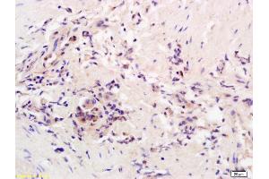Formalin-fixed and paraffin embedded human colon carcinoma labeled with Rabbit Anti AADAC Polyclonal Antibody, Unconjugated (ABIN1387867) at 1:200 followed by conjugation to the secondary antibody and DAB staining (AADAC antibody  (AA 228-273))