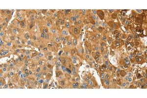 Immunohistochemistry of paraffin-embedded Human liver cancer tissue using ANXA9 Polyclonal Antibody at dilution 1:30 (Annexin A9 antibody)