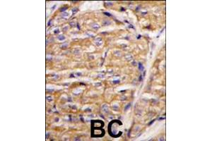 Formalin-fixed and paraffin-embedded human breast carcinoma tissue reacted with MIPEP antibody , which was peroxidase-conjugated to the secondary antibody, followed by DAB staining. (MIPEP antibody  (N-Term))