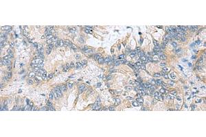 Immunohistochemistry of paraffin-embedded Human lung cancer tissue using TAGLN3 Polyclonal Antibody at dilution of 1:70(x200) (Transgelin 3 antibody)