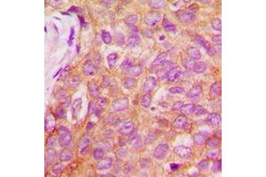 Immunohistochemical analysis of IRS1 (pS1101) staining in human breast cancer formalin fixed paraffin embedded tissue section. (IRS1 antibody  (C-Term, pSer1101))