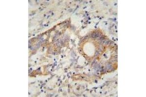 Immunohistochemistry analysis in formalin fixed and paraffin embedded human colon carcinoma reacted with AP52042PU-N, which was peroxidase conjugated to the secondary antibody and followed by DAB staining. (HHLA2 antibody  (N-Term))