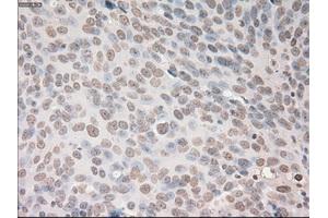 Immunohistochemical staining of paraffin-embedded Adenocarcinoma of breast tissue using anti-VEGF mouse monoclonal antibody. (VEGF antibody  (AA 27-233))