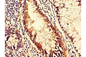 Immunohistochemistry of paraffin-embedded human colon cancer using ABIN7147114 at dilution of 1:100 (CD151 antibody  (AA 125-199))