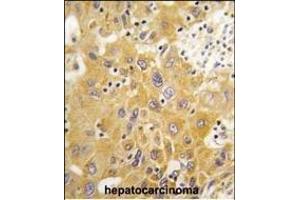 Formalin-fixed and paraffin-embedded human hepatocarcinoma tissue reacted with CK1-like Antibody (C-term) (ABIN391307 and ABIN2841342) , which was peroxidase-conjugated to the secondary antibody, followed by DAB staining. (CAMK1D antibody  (C-Term))