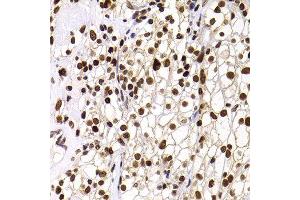 Immunohistochemistry of paraffin-embedded human well-differentiated squamous skin carcinoma using PHIP antibody at dilution of 1:100 (40x lens). (PHIP antibody)