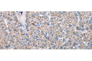 Immunohistochemistry of paraffin-embedded Human liver cancer tissue using FKBPL Polyclonal Antibody at dilution of 1:50(x200) (FKBPL antibody)