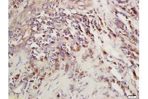 Formalin-fixed and paraffin embedded human laryngeal carcinoma labeled with Rabbit Anti-CEP120 Polyclonal Antibody, Unconjugated (ABIN2172950) at 1:200 followed by conjugation to the secondary antibody and DAB staining (CEP120 antibody  (AA 351-450))