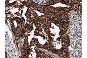 IHC-P Image VCAM1 / CD106 antibody detects VCAM1 / CD106 protein at cell membrane in human cervical carcinoma by immunohistochemical analysis.