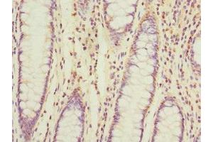 Immunohistochemistry of paraffin-embedded human colon cancer using ABIN7159901 at dilution of 1:100 (TIMM17A antibody  (AA 1-171))